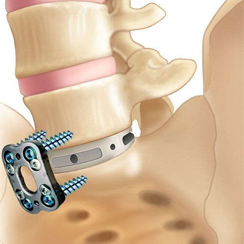 Anterior Lumbar Interbody Fusions