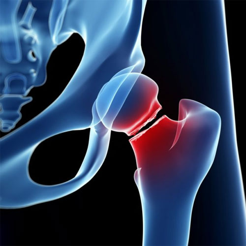 Osteoporotic Fractures treatment in Hyderabad