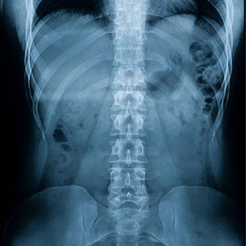 spinal fusion treatment in hyderabad
